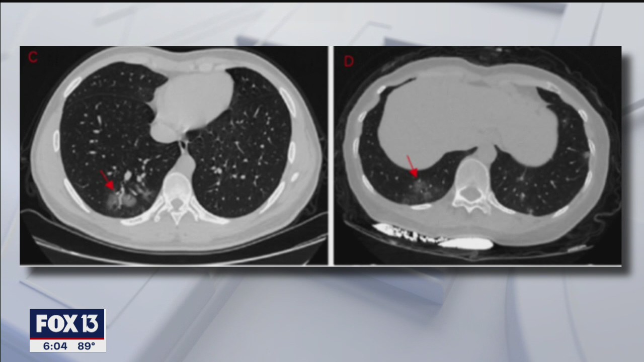 COVID-19 and lung damage