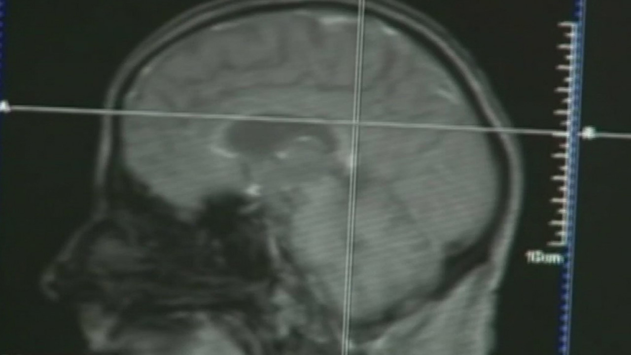 Coronavirus survivors experience brain fog