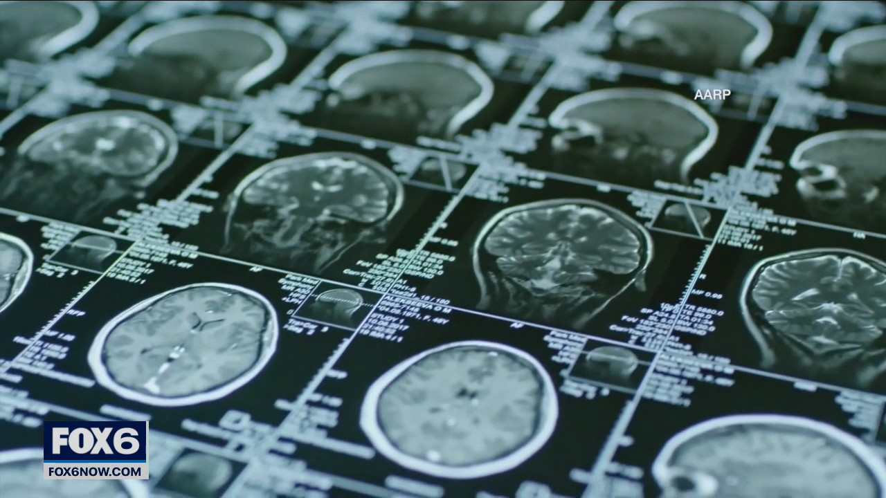 Volunteers needed for UW Alzheimer's study