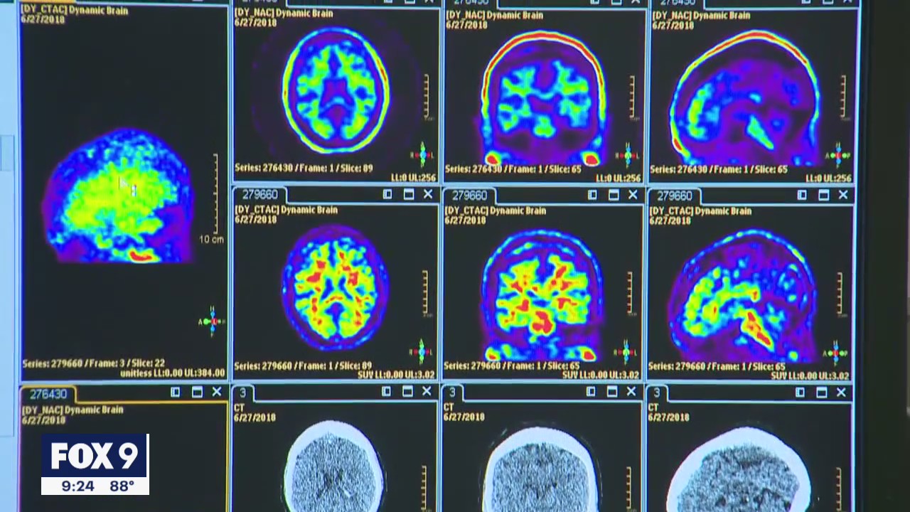 FDA approves new Alzheimer's drug