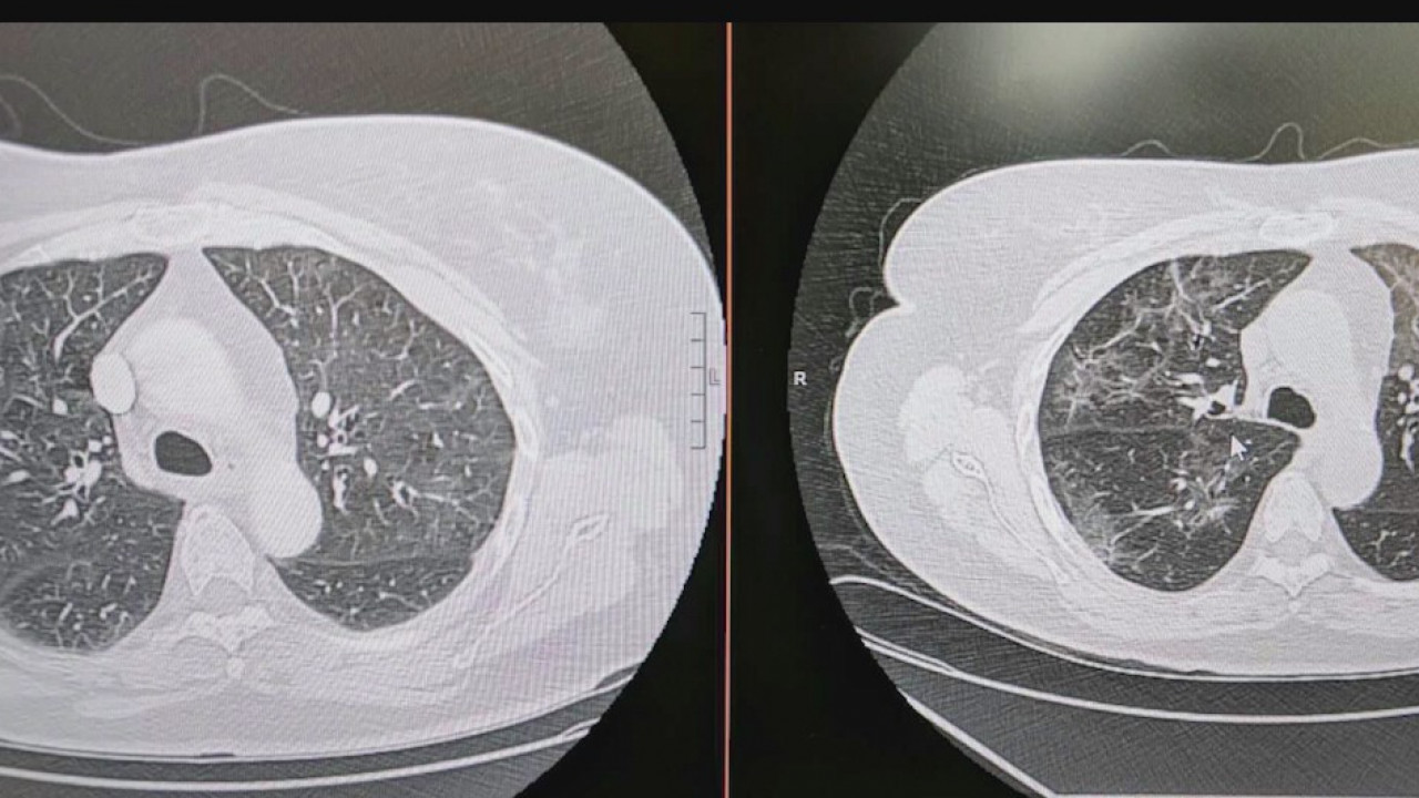 COVID-19 long haulers share experiences of inhalers, hazy lung scans