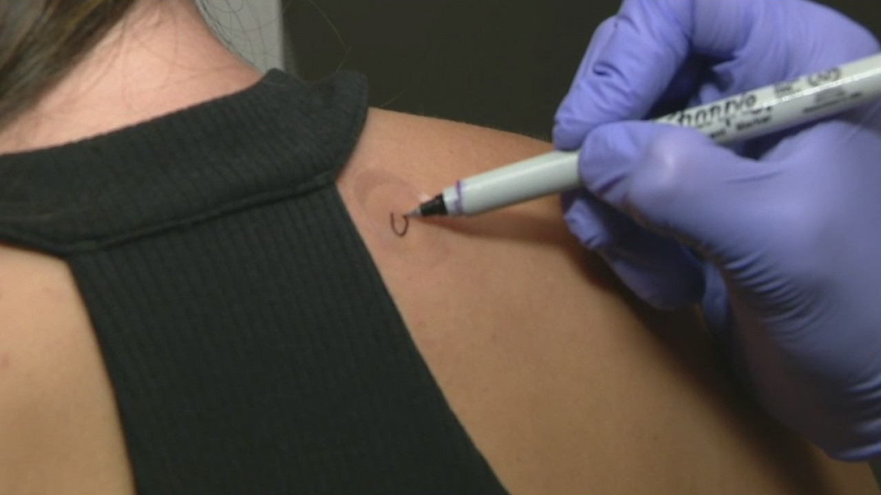 Dermtech sticker collects skin cells so doctors can test for cancer