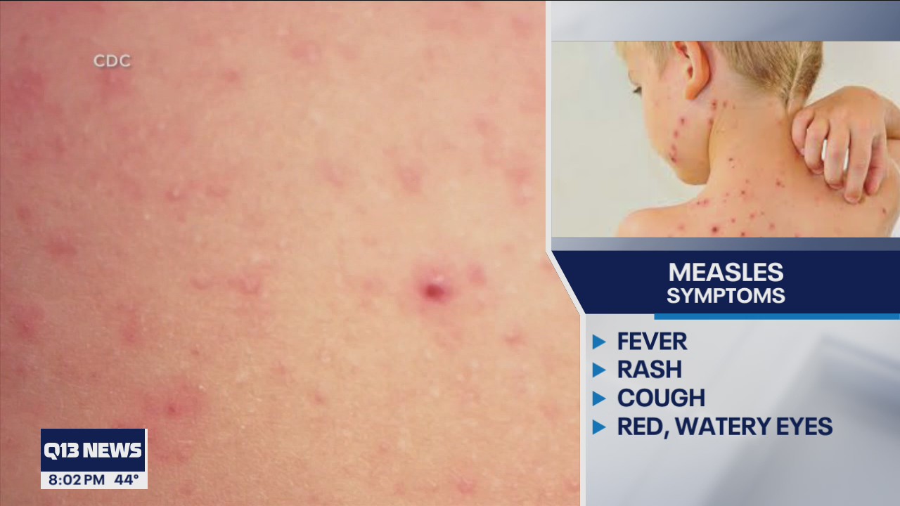 King County health officials warn of possible measles exposures at SEA airport