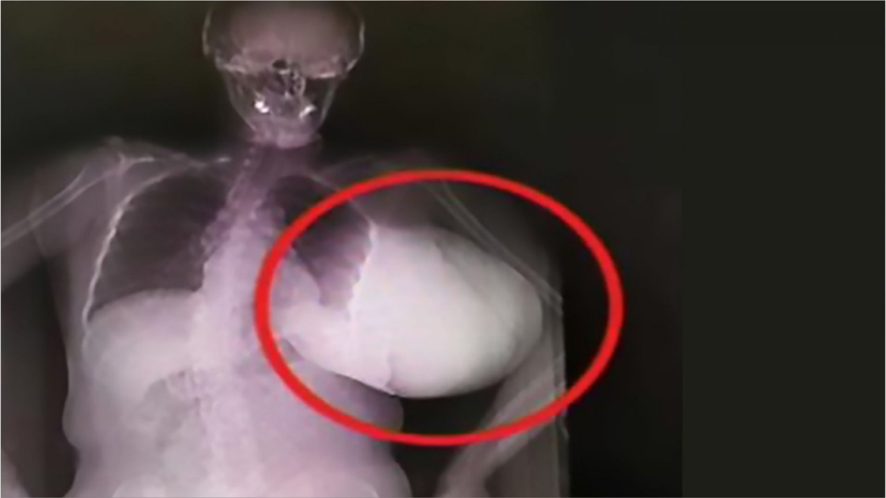 Woman has 'basketball-sized' breast tumor removed after letting it grow for 2 years, report says