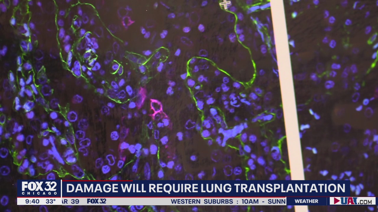 Northwestern study finds COVID-19 can result in irreversible lung damage