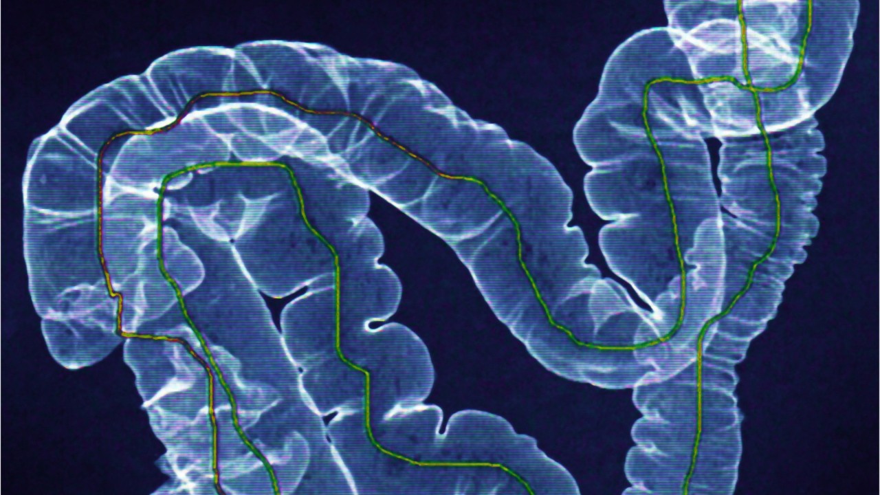 Colon cancer screenings should begin at age 45, not 50