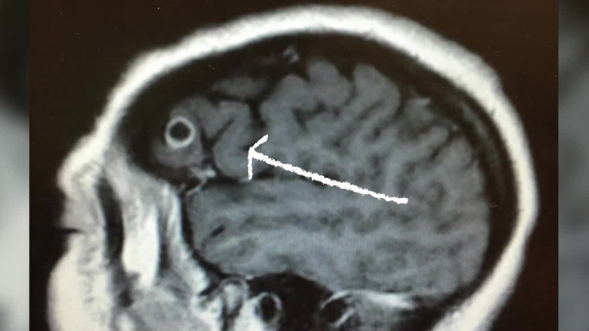 Surgeons find tapeworm egg in woman's brain