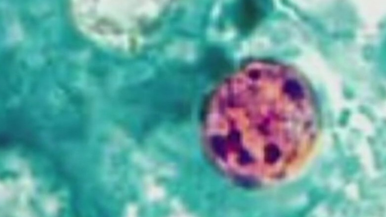 Your Health with Dr. Kumar: Cyclosporiasis