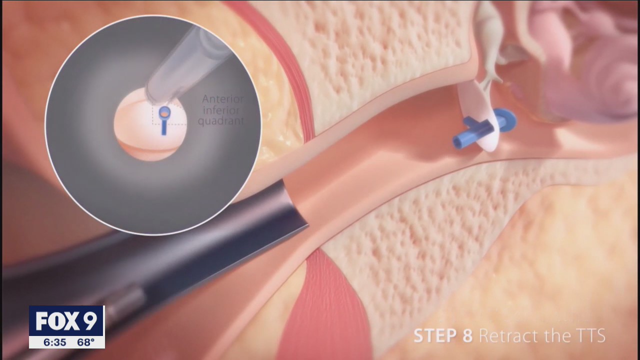 Minnesota company offering easier ear infection treatment for kids that can be done at a doctor's office