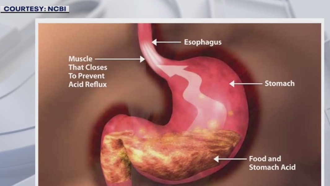 Growing number of people under 50 getting esophageal cancer diagnosis