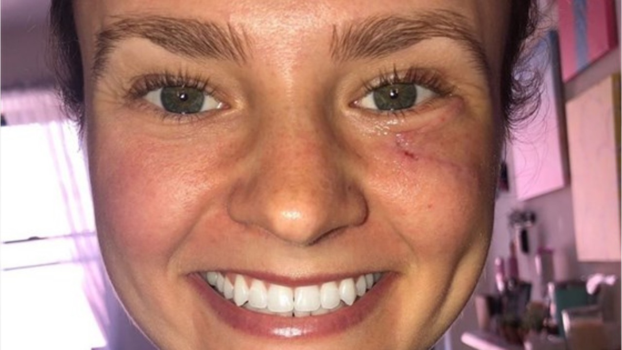 Woman, 24, recovering from skin cancer on face after she thought it was pimple