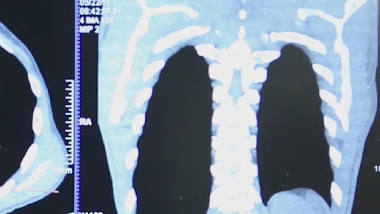 78-year-old man shares reminder to not skip out on lung cancer screenings
