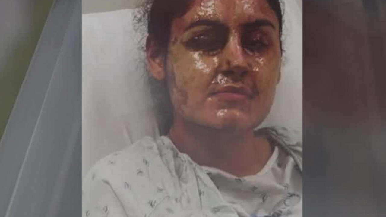 Acid attack on Long Island