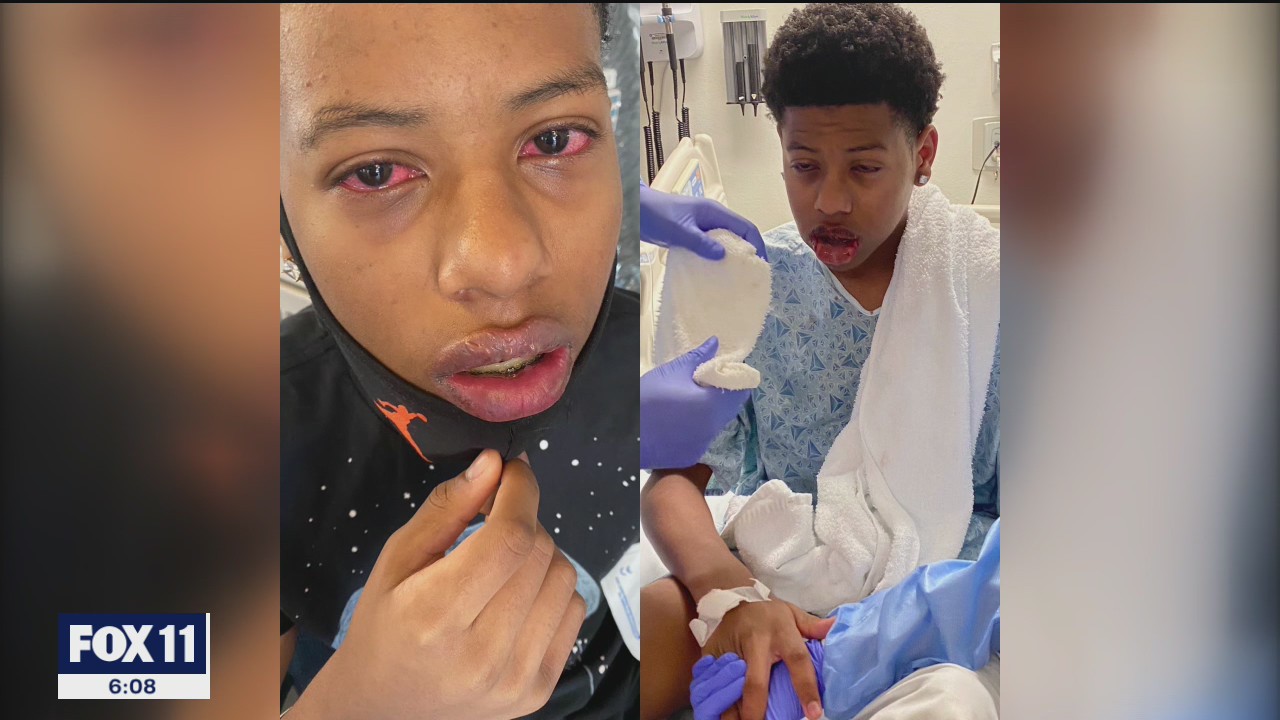 Teen speaks out after contracting COVID-19