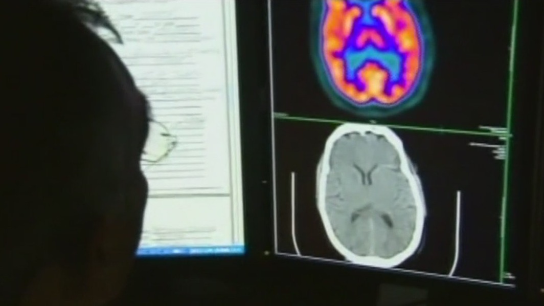 Brain fog plagues many COVID-19 survivors
