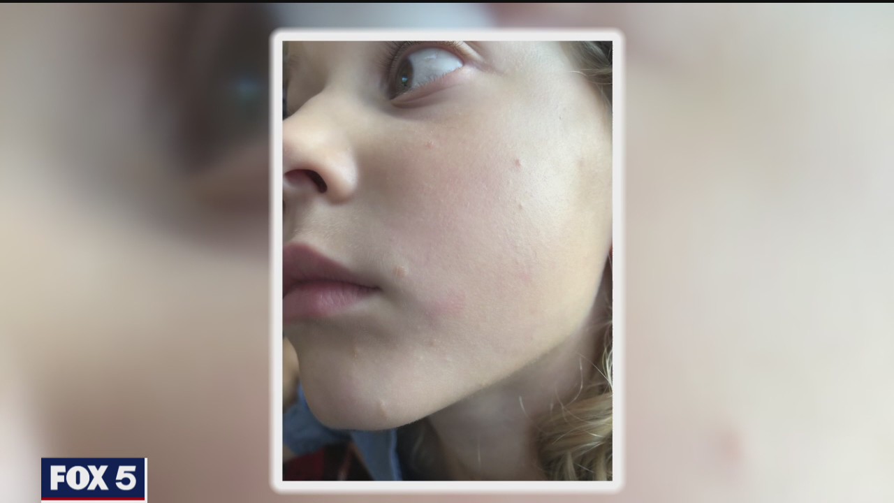 Girl stung by poisonous caterpillar