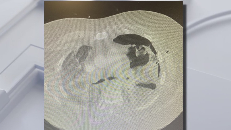 LIVE: Thoracic surgeon talks COVID effects on lungs
