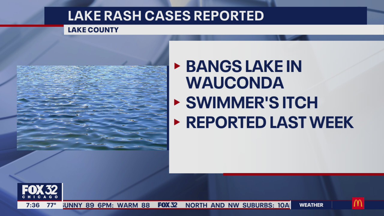 Warning issued after spike in cases of severe lake rash in Wauconda