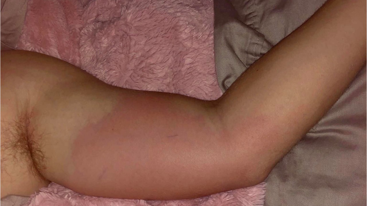 Florida man contracts flesh-eating bacteria while going about ‘an average day,’ not entering water