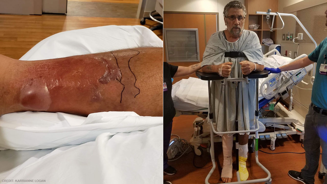 Florida man nearly dies from flesh-eating bacteria he mistook for bad sunburn
