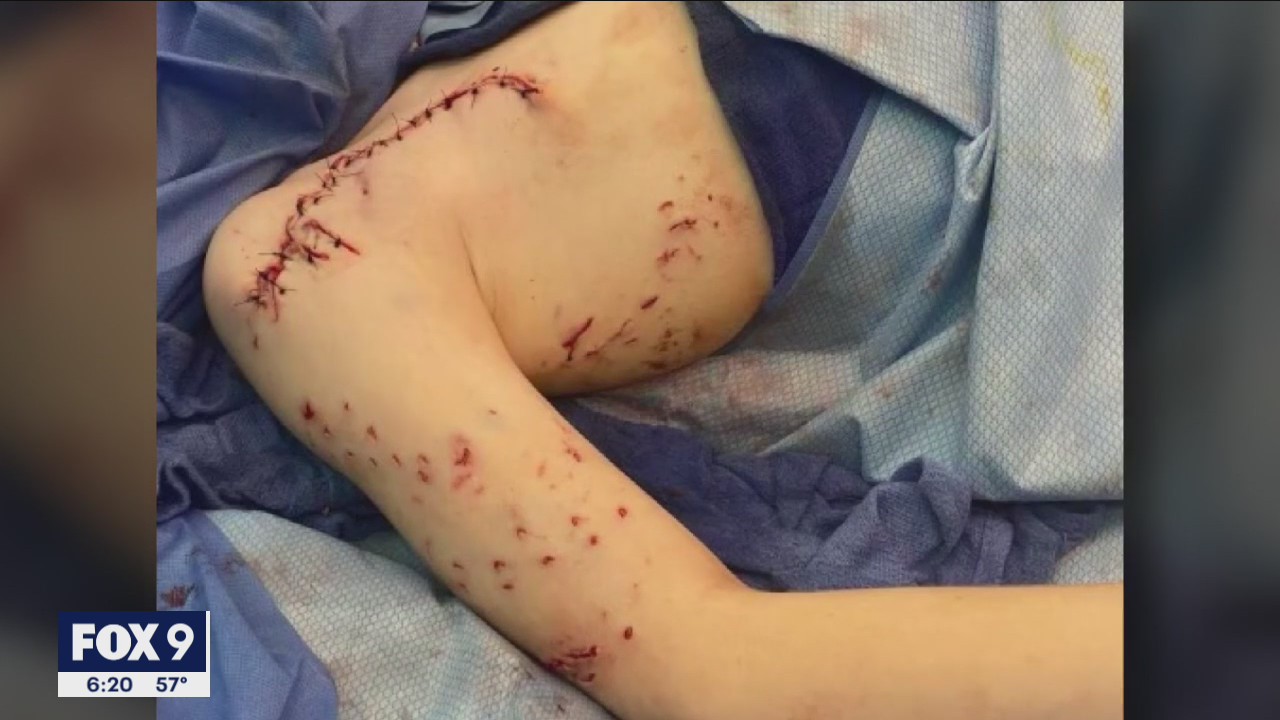 Minnesota boy survives shark attack in Miami