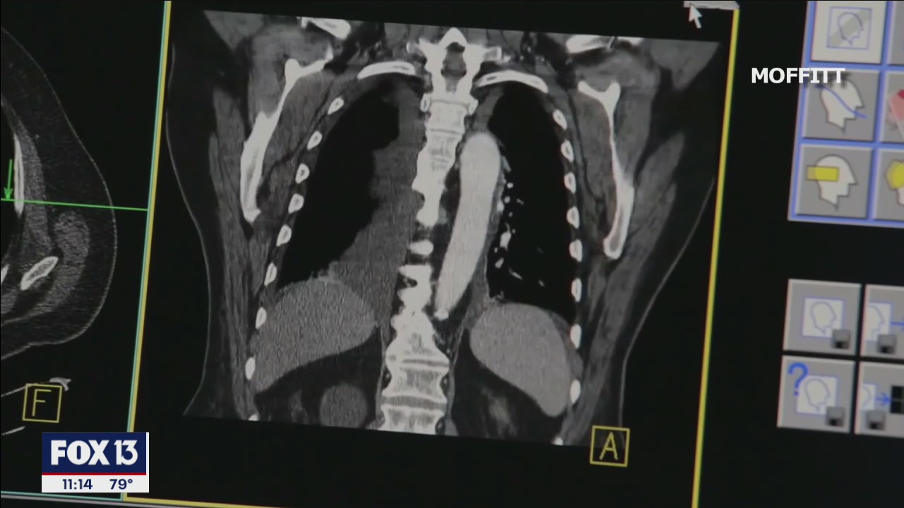 New tool to find prostate cancer