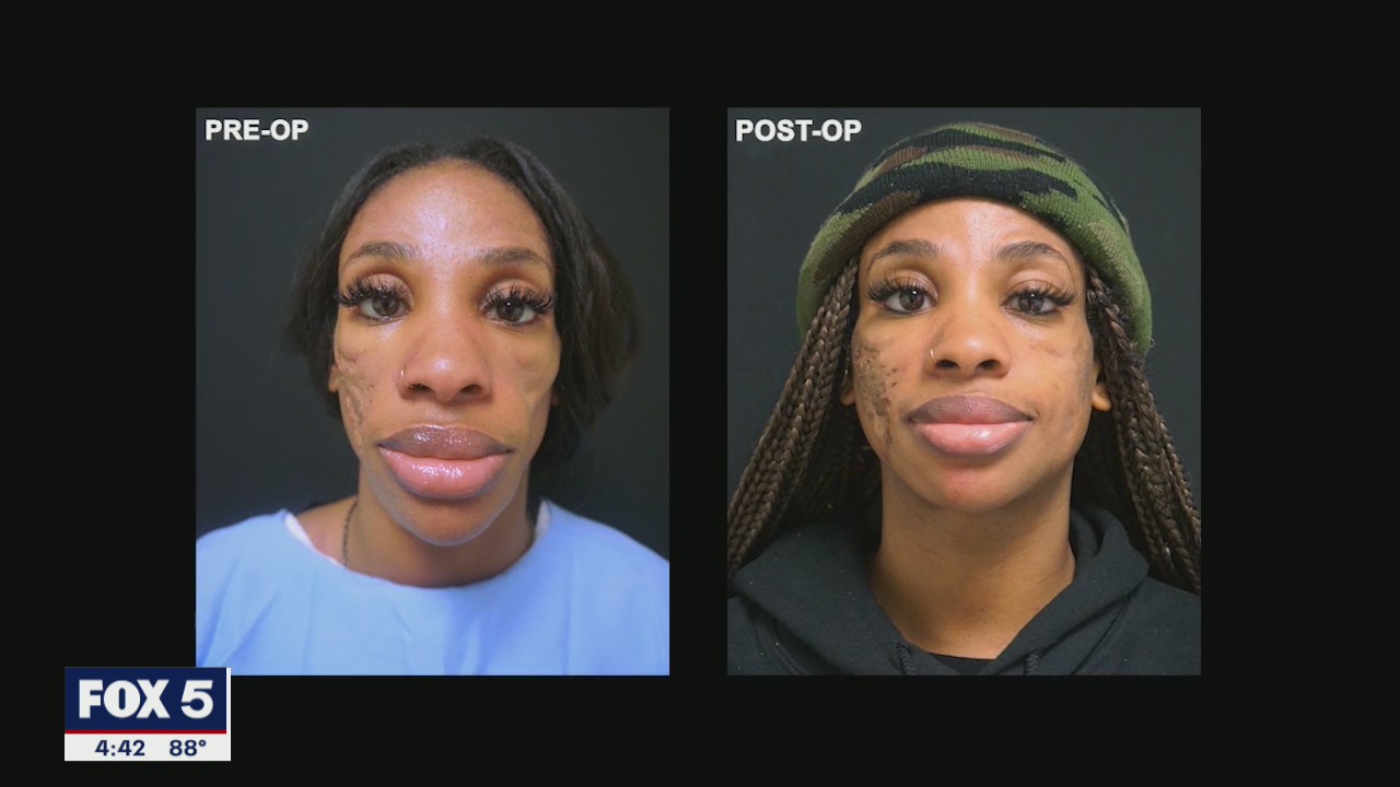 Atlanta woman sees plastic surgery as second chance after Lupus diagnosis