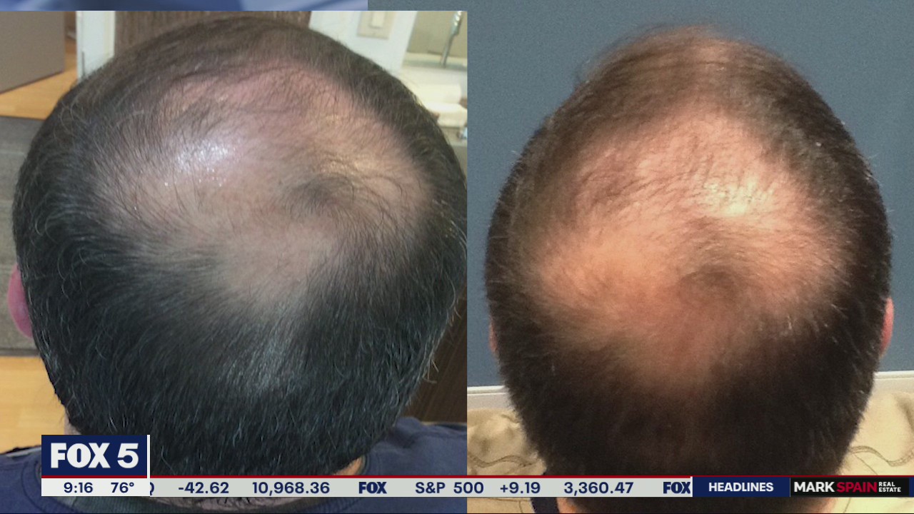 National Hair Loss Awareness Month